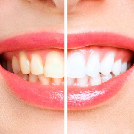 Estética Dental 10 woman teeth before and after whitening. Over white background. Dental clinic patient. Image symbolizes oral care dentistry, stomatology.