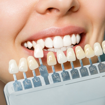 Estética Dental 8 Smiling young woman. Cosmetological teeth whitening in a dental clinic. selection of the tone of the implant tooth.