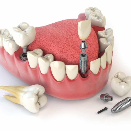 Implantes Dentales 25 Tooth human implant. Dental concept. Human teeth or dentures. 3d illustration