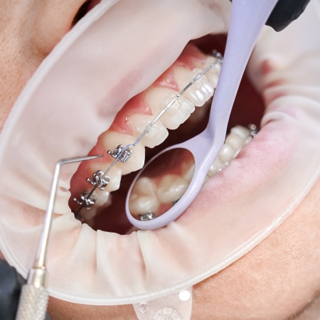 Ortodoncia Convencional 6 Close up of orthodontist using cofferdam and dental instruments while placing orthodontic brackets on patient teeth. Concept of stomatology, dentistry and orthodontic treatment.