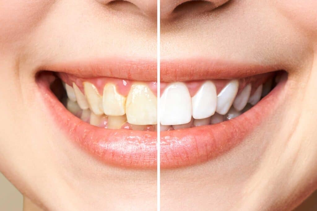 Blanqueamiento-Dental-10-1024x682