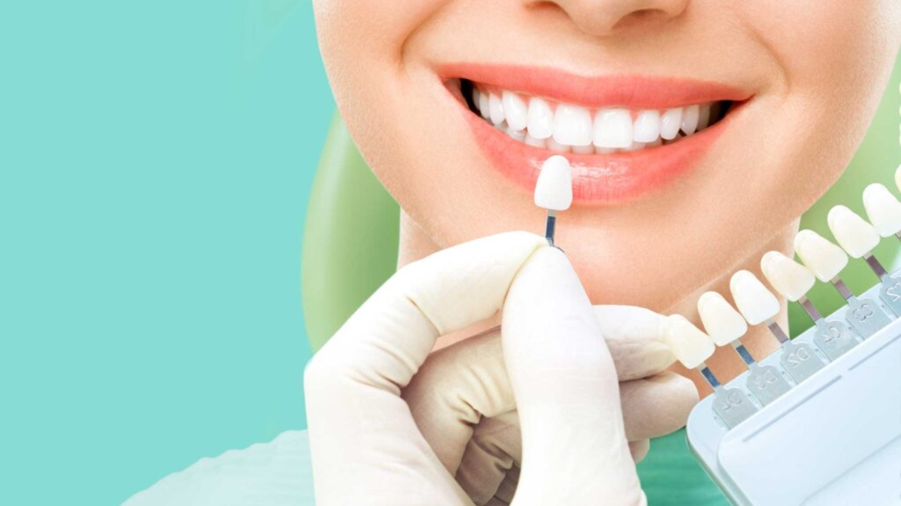 Blanqueamiento-Dental-12-1024x682