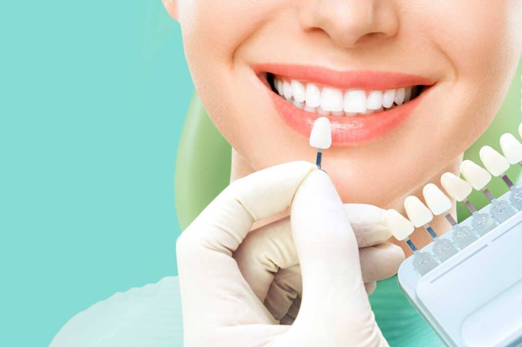 Blanqueamiento-Dental-12-1024x682
