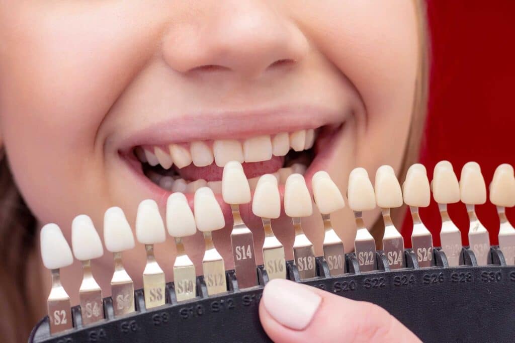 Blanqueamiento-Dental-6-1024x682