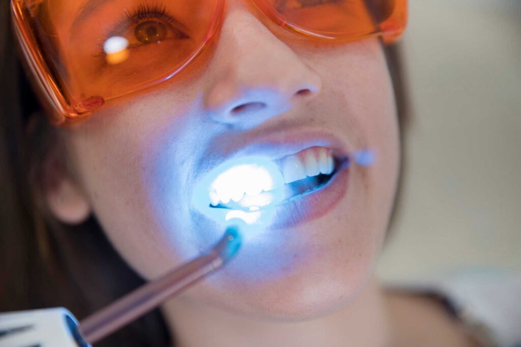 Blanqueamiento-Dental-8-1024x682