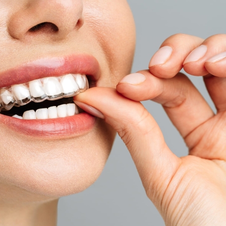 Invisalign First 9 A young woman does a home teeth whitening procedure. Whitening tray with gel.