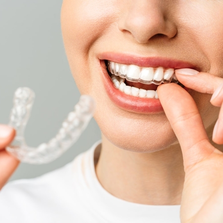 Invisalign Comprehensive 6 A young woman does a home teeth whitening procedure. Whitening tray with gel.